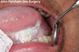 John Farnham Jaw Surgery
